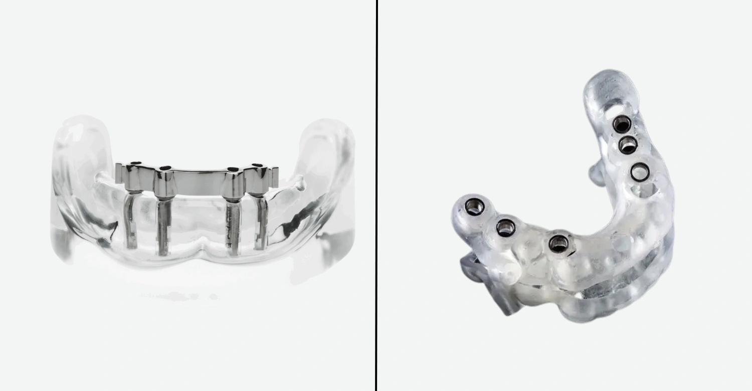 3D Printed vs Milled Titanium Implant Inblog
